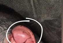 La imagen que recorre el mundo: un luchador de MMA le mordió la oreja a su rival durante una pelea